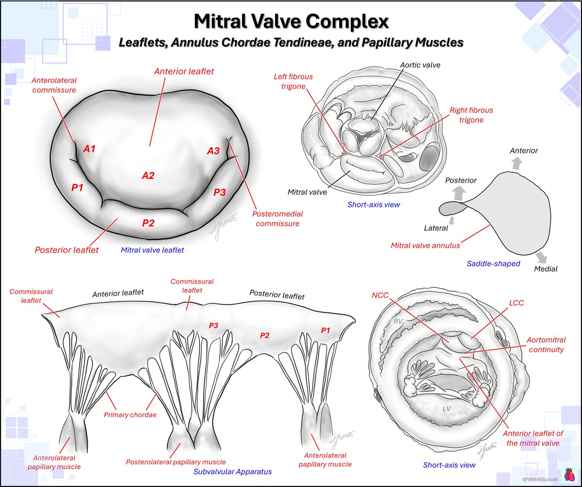 WithAScalpel's tweet photo. Mitral Valve Complex🪂🧐
👉The mitral valve is an integrated apparatus composed of the anterior and posterior leaflets, saddle-shaped annulus, chordae tendineae, and papillary muscles.
👉The posterior leaflet is organized into P1–P3 scallops, with corresponding A1–A3 segments of the anterior leaflet forming the opposing coaptation zones.
👉Leaflet coaptation is stabilized by primary and secondary chordae arising from the anterolateral and posteromedial papillary muscle groups.
@PWesslyMD @SIwa23288585 @LucySafi @PriyaPanday27 @NadeenFaza @HeartToProve @ASE360 @JournalASEcho