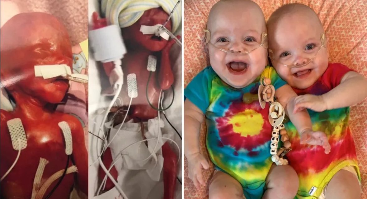 LilaGraceRose's tweet photo. Meet Adiah and Adrial Nadarajah.

Born at just 22 weeks, the most premature twins recorded in history.

Doctors said they were not viable, giving them an alleged 0% chance of survival

They defied the odds and fought to live.

Today they're 4, healthy, and thriving. https://t.co/SKjwCHIjDx