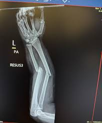 FromTalik's tweet photo. @RepLuna Breaking: @RepLuna has just released the X-Ray of her arm following this vicious assault. This woman is lucky to be alive! #CodePink https://t.co/3Z6yhZSpRt