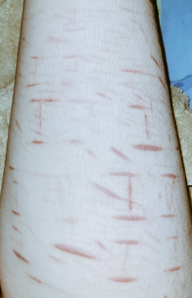 servantofshtwt's tweet photo. Tw: cutting
Another sesh like I said + scar tour (more in replies)
#shtwt #slittwt #shedtwt #selfharm #cutting #sitwt https://t.co/0BpYJAfAk1