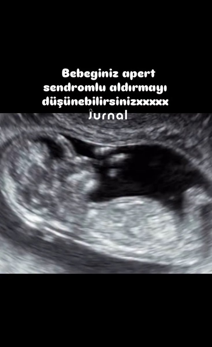 jurnalhabertr's tweet photo. Doktorun, “Bebeğiniz Apert sendromlu, aldırmayı düşünebilirsiniz.” uyarılarına rağmen doğum yapan kadın:

“Sevemedik fikrinizi.” https://t.co/82CiLFmekk