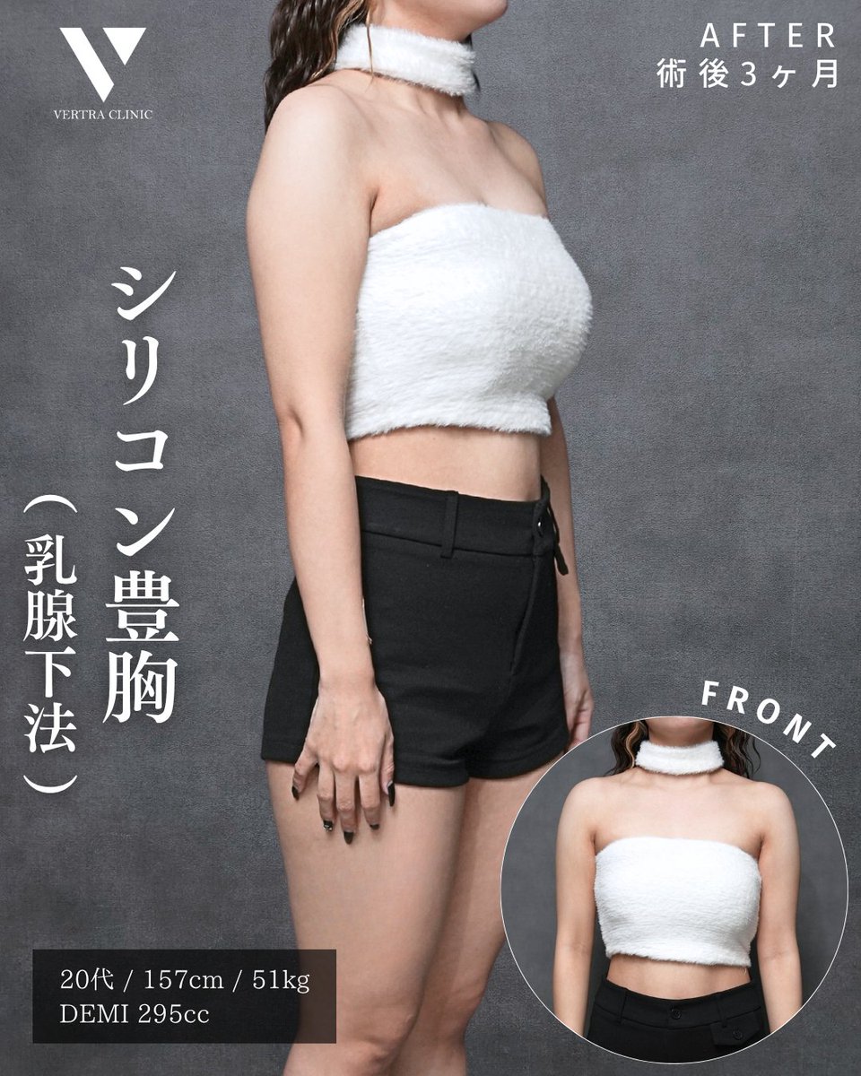 vertraclinic's tweet photo. 《 施術内容 》 
シリコン豊胸(乳腺下法)  

《 執刀医 》 
大阪院院長 河中 聡之(@Dr_kawanaka)  

《 詳細 》 
女性/20代/157cm/51kg 
シリコンバッグ：motiva エルゴノミクス2 
シリコンサイズ：DEMI 295cc 
挿入部位：脇下 https://t.co/z5wWWS9e6D