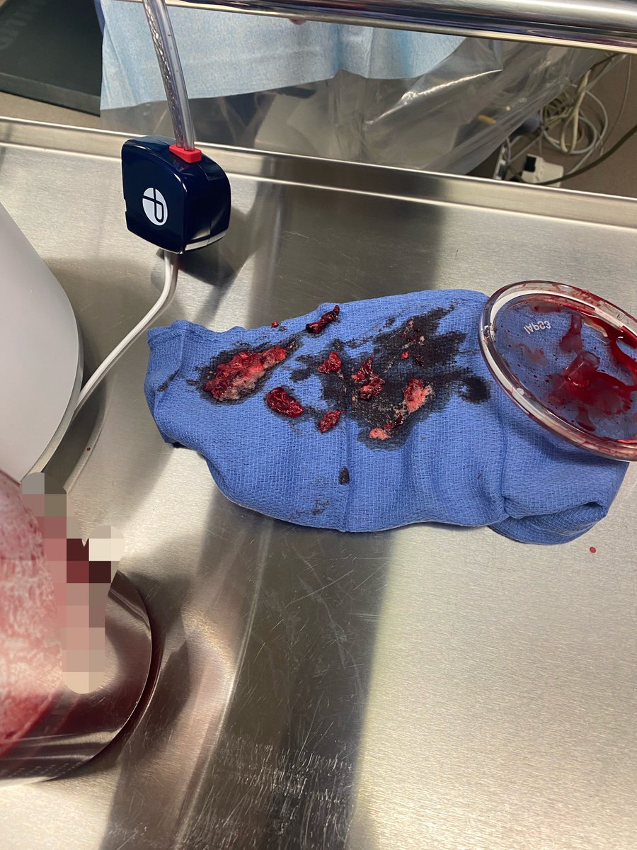2thewilberforce's tweet photo. Sensitive medical warning. 

What they removed today. https://t.co/hXTjneCI5a