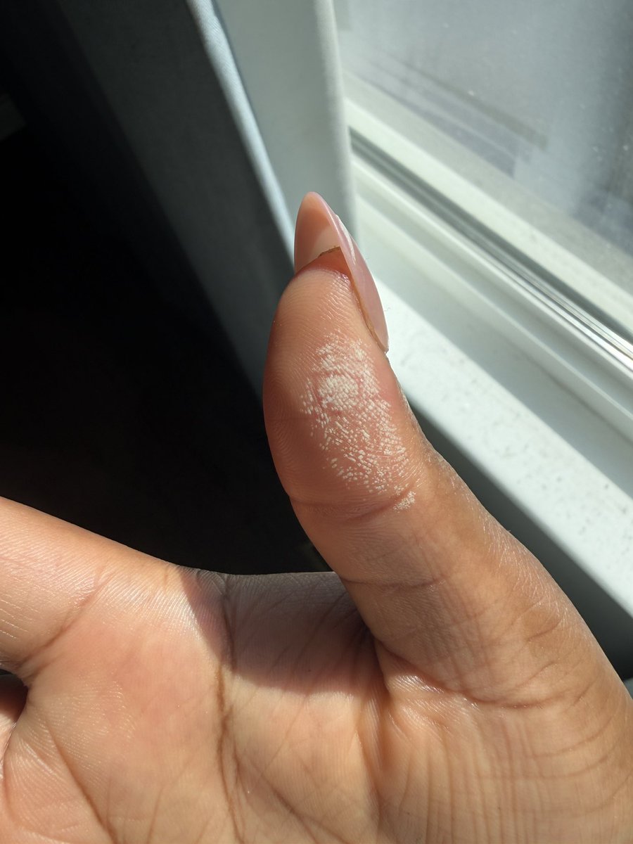 edenstudioarc's tweet photo. got a chemical burn today and couldn’t believe my eyes https://t.co/8tiwWNW88X