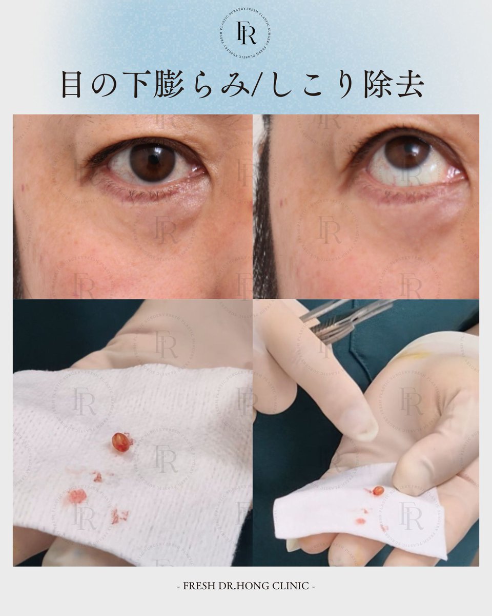 freshps5512's tweet photo. ⚠️ 最近増えている「副作用治療・修正治療」
こちらは肉芽腫（しこり）除去の症例です。

患者様ご本人も、
「これまで色々な施術を受けていて、何が原因でしこりになったのか覚えていない」とのことでした。
フィラー注入やコラーゲン注射などの施術後、
✔ しこりができた
✔ 硬くなった
✔ 違和感が続いている
✔ 見た目が不自然になった
このようなお悩みでご来院される方が増えています。

美容施術にはメリットだけでなく、副作用や予期せぬトラブルが起こる可能性もあります。
「これって大丈夫かな？」
「他院で施術したけど相談したい」
そんな方は一人で悩まず、
フレッシュホンドクター整形外科までお気軽にご相談ください✨
無料LINEカウンセリング受付中📩

#肉芽腫除去
#しこり除去
#副作用治療
#フレッシュホンドクター整形外科