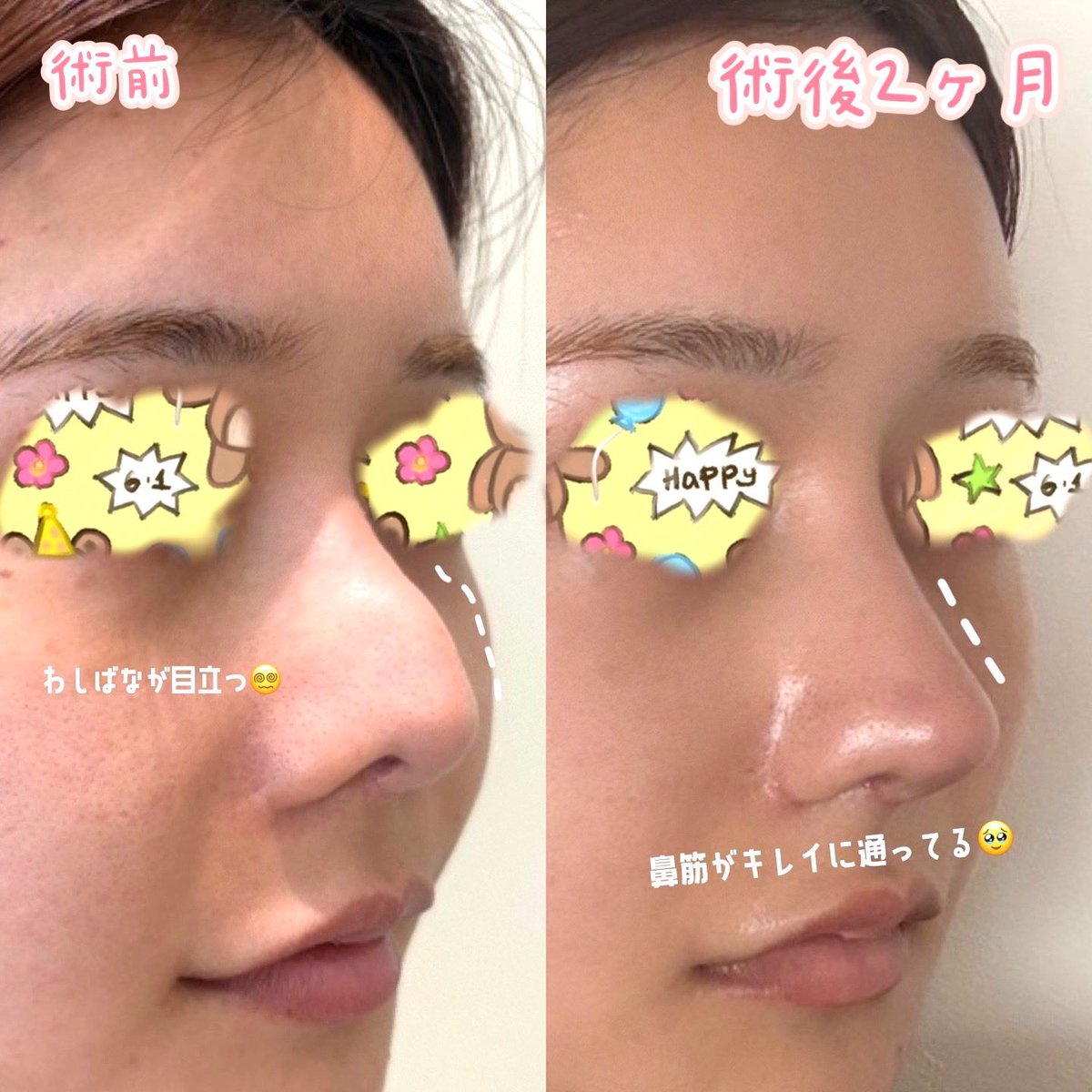 on8p6o's tweet photo. ミジャクで鼻オペして2ヶ月目経過しました。
1ヶ月目よりもはるかに鼻の浮腫が取れてスッキリはしました。全体的な形はとても自然な鼻の印象で気に入っています。
あとは鼻柱のあたりの鼻先がもう少しスッキリして、あと少しだけ鼻が低くなってくれたら完璧です！ https://t.co/VPfZijteEC