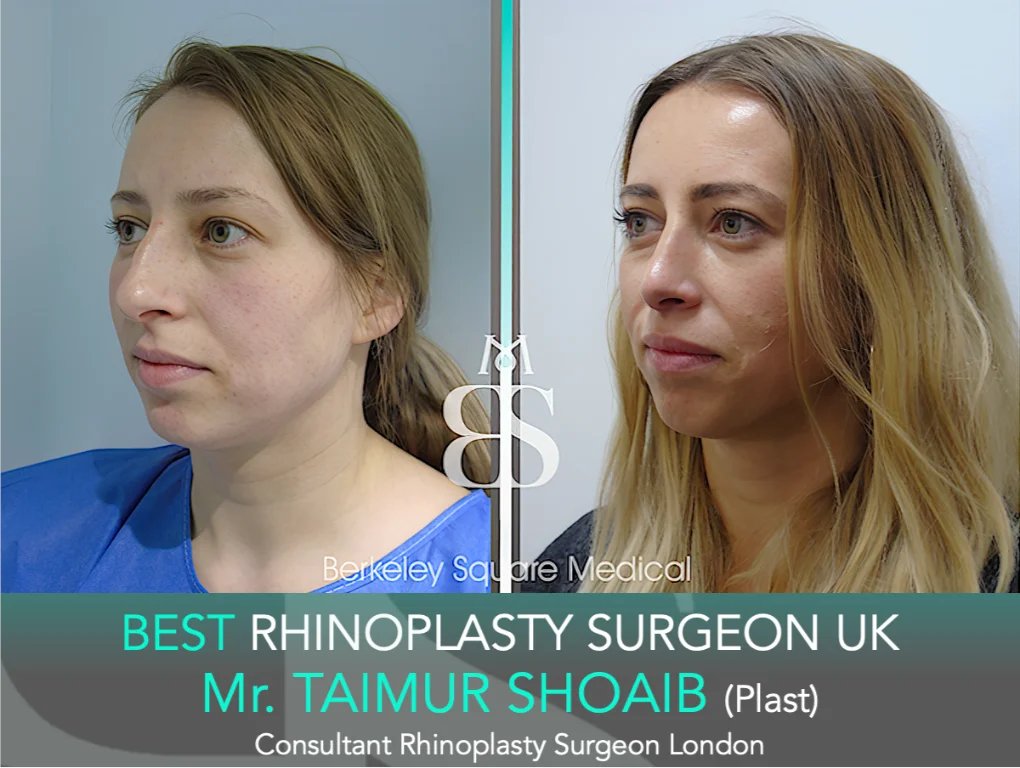 BerkeleySqMed's tweet photo. Refined Proportion with Timeless Facial Balance
31-Year-Old Female Rhinoplasty | Tip Reduction & De-Projection by Mr. Taimur Shoaib

A sincere thank you to our patient for allowing us to share her results to help educate others considering rhinoplasty.

Our Patient’s Journey:
At 31, she felt her nose appeared slightly too large for her facial features and drew attention away from the balance of her face. She wanted a natural refinement that would enhance harmony without changing her overall appearance. After consultation, she chose Berkeley Square Medical for a subtle and proportionate result.

Aim:
Rhinoplasty was performed to reduce the nasal tip, straighten the profile, and decrease projection to create a more balanced and harmonious facial appearance.

Results Achieved:
✔️ Nose Centralised
✔️ Mild Tip Reduction
✔️ Straighter Side Profile
✔️ Columella / Tip Angle Corrected
Surgery performed by Mr. Taimur Shoaib @ Berkeley Square Medical.

📍 Berkeley Square Medical | London
https://t.co/6RtmEGnaA7

#Rhinoplasty #RhinoplastyLondon #RhinoplastyBeforeAndAfter #NoseJobUK #BerkeleySquareMedical #rhinoplastysurgeon #RhinoplastyUK #NoseJobLondon #rhinoplastyuk #nosejobuk #bestrhinoplastysurgeonuk