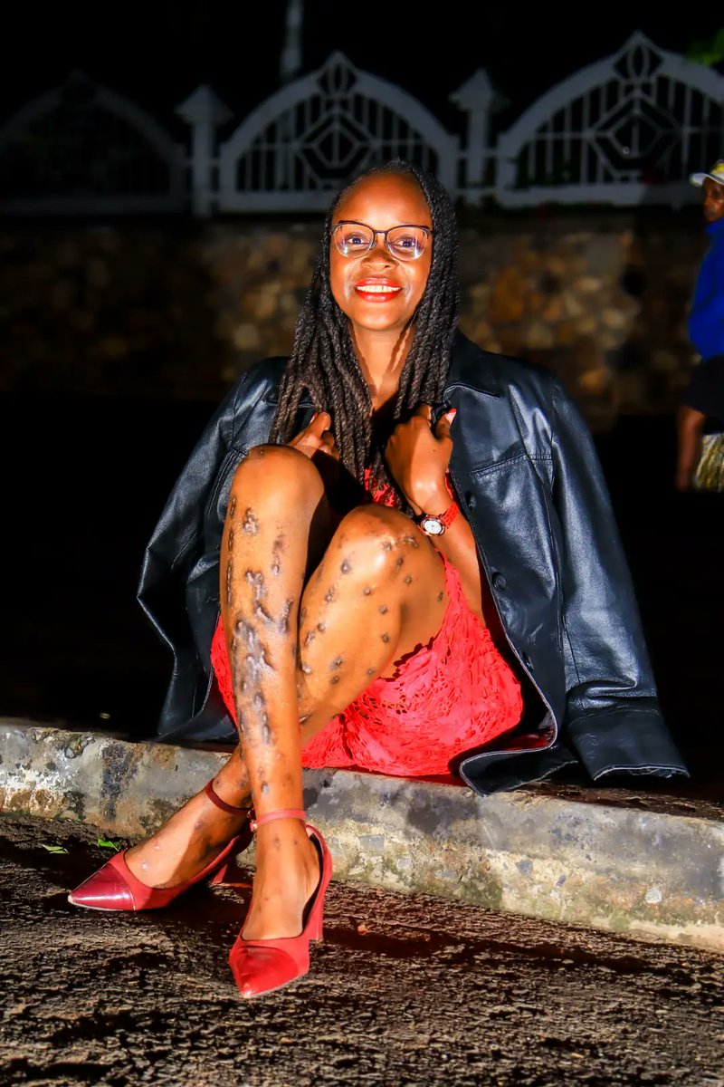 fagnetta's tweet photo. What’s a physical or mental battle you fight that most people completely underestimate?
​For many, it's Eczema. It’s often dismissed as "just dry skin," but the physical pain and emotional weight it carries are heavy. https://t.co/kqimx4MCky