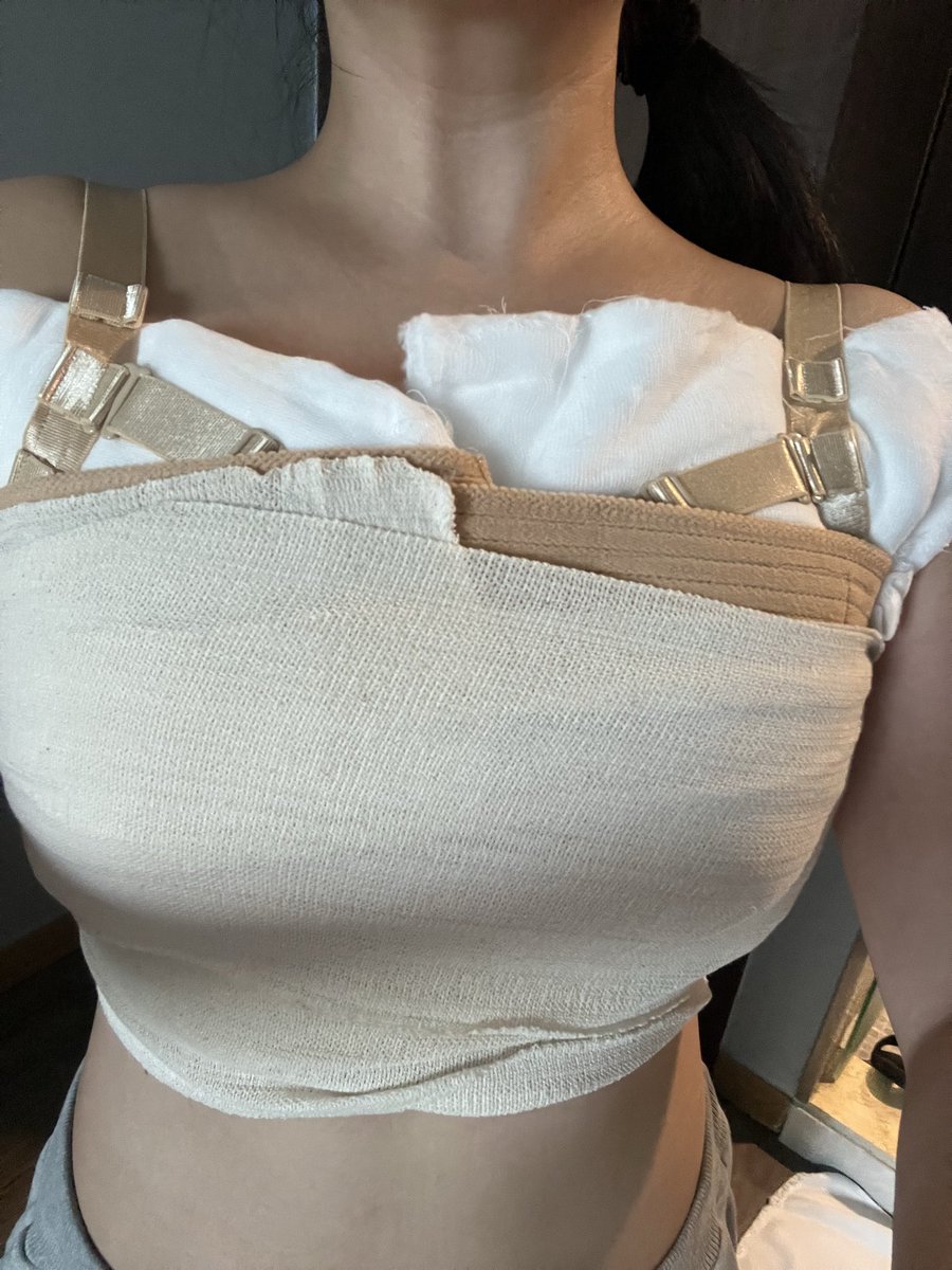 acha626oo's tweet photo. 6/1 NOTE美容外科にて豊胸手術をしましたので当日の流れをレポいたします！シリコン豊胸メンター325ccを入れました。切開位置は元々アンダーバストを希望してましたが、カウセで脇下切開にする事にしました。当日日本語通訳の方もいてスムーズでした
＃ノート美容外科Arté  ＃豊胸手術  @notejp_arte https://t.co/Zkbphacuy1