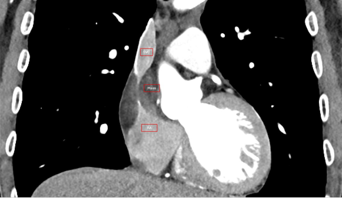 hsfeditor's tweet photo. 💡"Could a year of #palpitations, dizziness &amp; chest pain hide a rare fatty heart mass crushing the vena cava? #CardiacSurgery #CardioTwitter #CaseReport #MedEd"

Know more👉: https://t.co/5UsIgTyotp

 #MedEd #Cardiology #Cardiology #HeartSurgery #MedicalResearch #CardiacImaging https://t.co/NErXo035JC