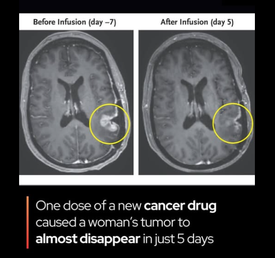 Rainmaker1973's tweet photo. A single dose of a new cancer drug made a brain tumor almost disappear – in just five days.

Doctors at Massachusetts General Hospital reported “dramatic and rapid” tumor regression in the first patients treated with a next-generation form of CAR T-cell therapy for glioblastoma, one of the most aggressive brain cancers known. 

The therapy, called CARv3-TEAM-E, was developed to overcome a major hurdle in treating solid tumors: their ability to hide from the immune system.

The personalized treatment reprograms a patient’s immune cells to attack the tumor, and in one extraordinary case, nearly eliminated the cancer within just five days. This novel therapy is designed to target multiple features of the tumor at once, a strategy that may help overcome the common challenge of treatment resistance in solid tumors like glioblastoma.

Although the tumors eventually returned, the early outcomes were described as unprecedented. One patient saw a 60% reduction in tumor size that lasted for half a year—an impressive result in a cancer known for its aggressiveness.

The trial’s success marks a major step forward for immunotherapy in brain cancer and raises new hopes for long-term control or even a cure. Researchers are now working to refine the treatment and extend its effects, with the ultimate goal of turning a once-terminal diagnosis into a survivable condition.