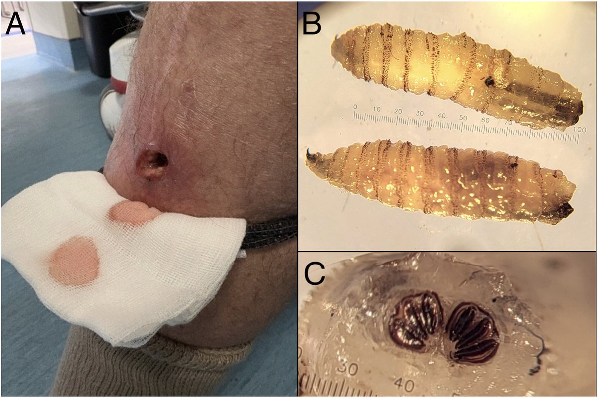 BogochIsaac's tweet photo. Screwworm has now reached Texas, breaching the barrier designed to keep it from moving north of Panama.

These larvae can devastate livestock. Human cases are less common but can be severe &amp; disfiguring.

We recently saw a case in Toronto in a traveller returning from Costa Rica. https://t.co/1XOkNKgCr6
