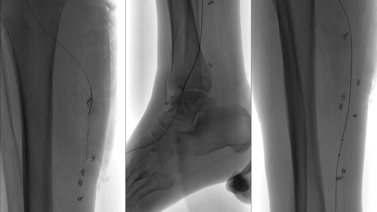 NikitoS888's tweet photo. Thrombosis of the #HDVA (hybrid artery of the deep veins of the foot) in patients with #CLTI. 1 photo - angiography 2 - recanalization and thrombaspiration #AngioJet @bostonsci , 3 - final result https://t.co/NRS4fwTTM6