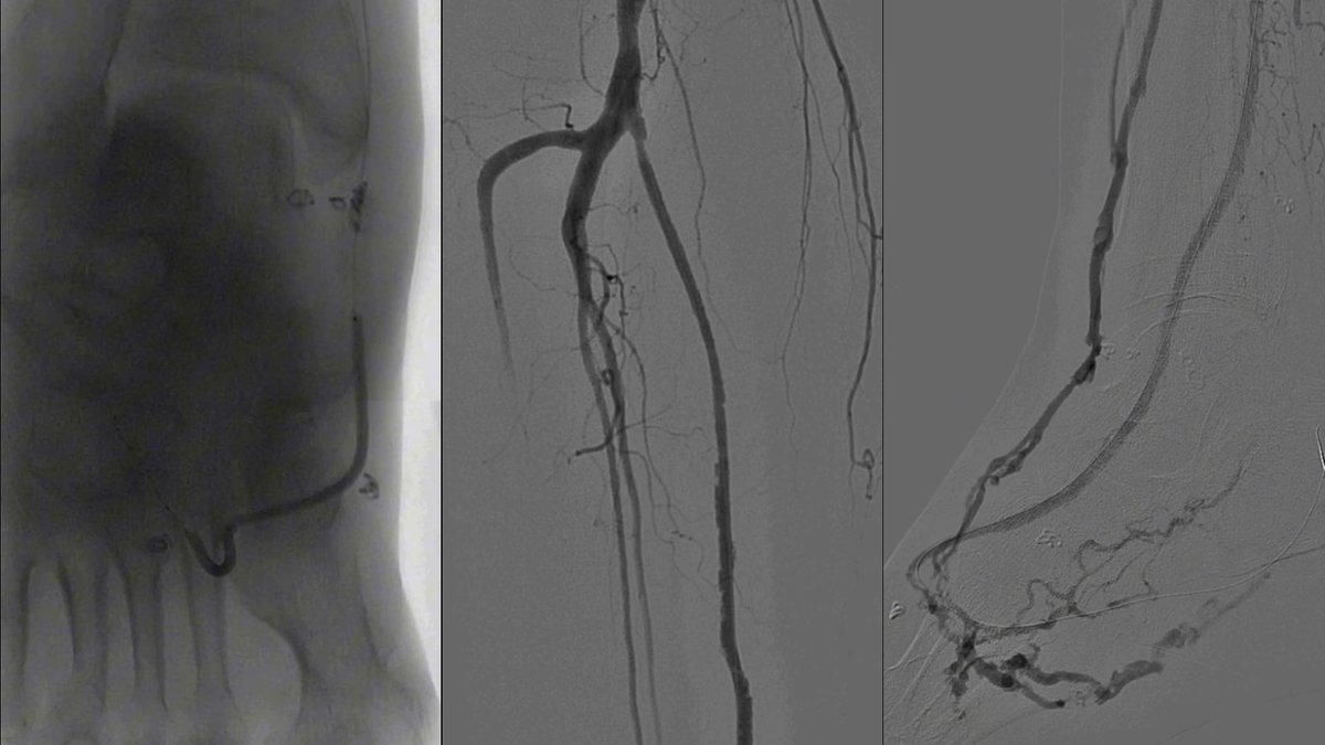 NikitoS888's tweet photo. Thrombosis of the #HDVA (hybrid artery of the deep veins of the foot) in patients with #CLTI. 1 photo - angiography 2 - recanalization and thrombaspiration #AngioJet @bostonsci , 3 - final result https://t.co/NRS4fwTTM6