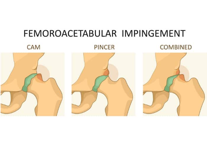 DrJeffPadalecki's tweet photo. #Pincer #impingement involves an over-covered hip socket that traps the labrum. While distinct, most patients have a "mixed" type, meaning they also have cam impingement on the femoral side. Understanding mechanical issues is key to effective treatment. https://t.co/EbEJjjsr9w https://t.co/oDmFHgmcCB
