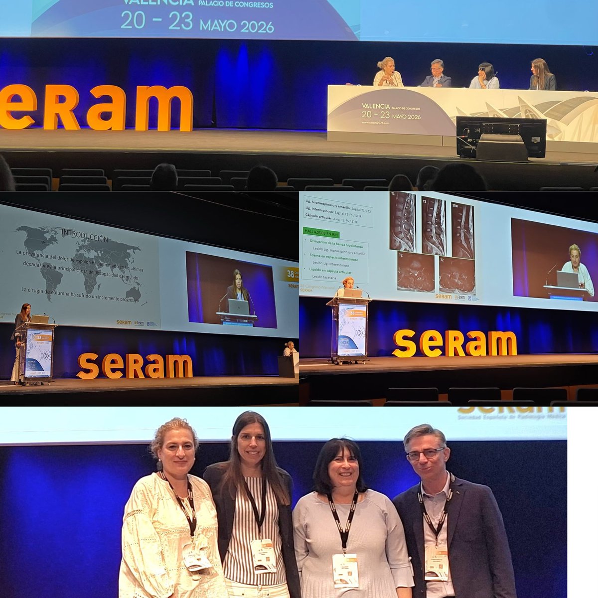 MskSerme's tweet photo. 🦴 Cerramos #SERAM2026 con una última mañana muy práctica de MSK: columna vertebral (qué debemos saber, material quirúrgico y puntos ciegos), lesiones musculoesqueléticas en Urgencias (fracturas ocultas, TC y ecografía) y cómo estructurar el informe de fractura paso a paso. https://t.co/nMAz4nVhRn