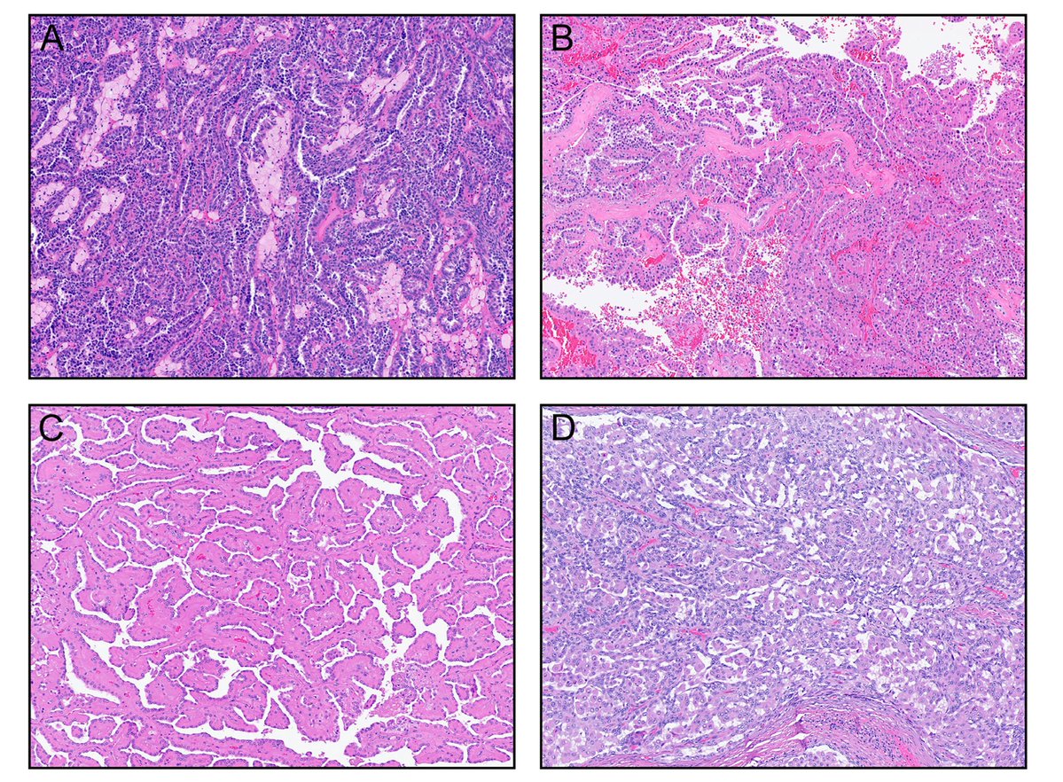 GTumors's tweet photo. Rare RCC is not one disease — it is an entire spectrum of biologically distinct tumors with unique molecular drivers. 🧬

Phenomenal review from the @cityofhope team describing the evolving molecular landscape of rare RCC and the urgent need for subtype-specific research and precision medicine approaches.

A must read for anyone interested in kidney cancer!

@ESadimin @ActuallyGZhang @montypal @CityofHope_GU @SpiessPhilippe @drgaganprakash @LuisMedinaMD @npaesa @CMercinelli @dramandeeparora @CurtisPettaway1 @MDAndersonNews @MoffittNews @TataMemorial  @AmerUrological @UroOnc @SUO_YUO @CAU_URO @AndreaNecchi @EauPatient @JadChahoud @PGrivasMDPhD @herneygarcia