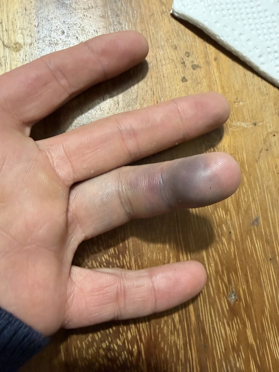 Ricky_leaks_'s tweet photo. Hace DOS meses que no pueden atender fracturas en el hospital Gea González porque somos Dinamarca verdad @zoerobledo.  Qué hagan una lista PÚBLICA de lo qué sí pueden hacer, estoy harto de tanta ineptitud https://t.co/yDK9j5jJxG