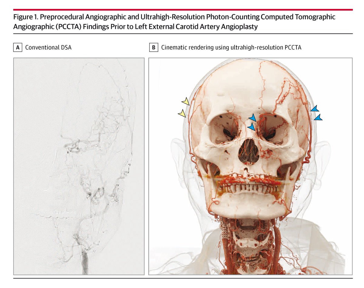 JAMANeuro's tweet photo. This case report describes a patient with left-sided weakness following transient ischemic attacks who underwent external carotid angioplasty based on findings from ultrahigh-resolution photon-counting computed tomographic angiography (CTA). https://t.co/T3N6DvjnnU https://t.co/CfAqrcw5Cx