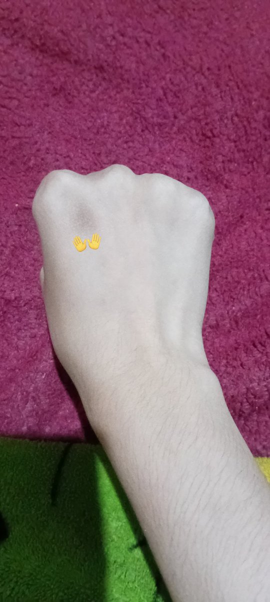 sa_isn's tweet photo. gais ada yg tau ga ya knp di tanganku ada bercak coklat, gak gatel/sakit tapi di area sana kulit nya agak mengelupas https://t.co/rGtkTLoTpF