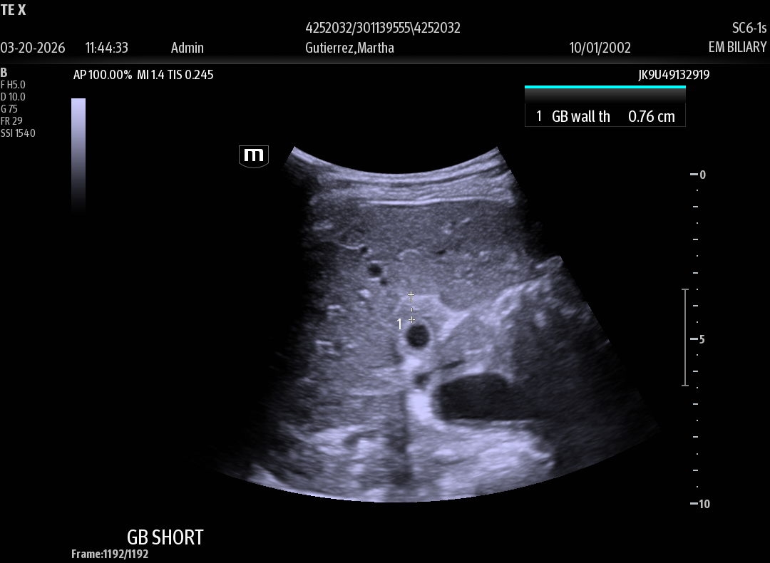 BrookdaleSono's tweet photo. “Probably gastritis” until the ultrasound exposes their SIN 👀

23 yo F with PMH Gastritis presenting for epigastric abdominal pain...

#Cholecystitis #POCUS #EmergencyMedicine #BrookdaleSono #StoneInNeck #FOAMed https://t.co/adCfPuW1bs