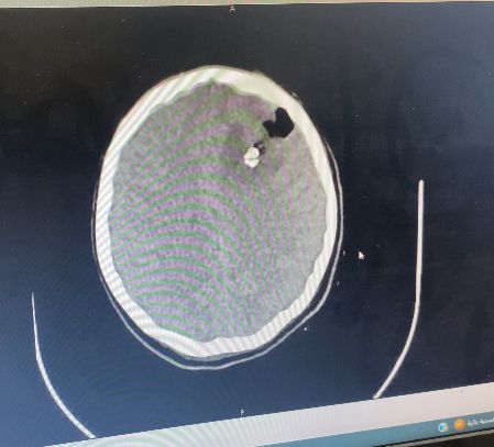 seeajw's tweet photo. Retaj survived the bullet… now she needs help surviving the aftermath.
Shrapnel is still inside her head, and her treatment journey is far from over😓
Please continue sharing and supporting her recovery

GFm: https://t.co/EhsQDlVQZe https://t.co/jGtzOaOafz