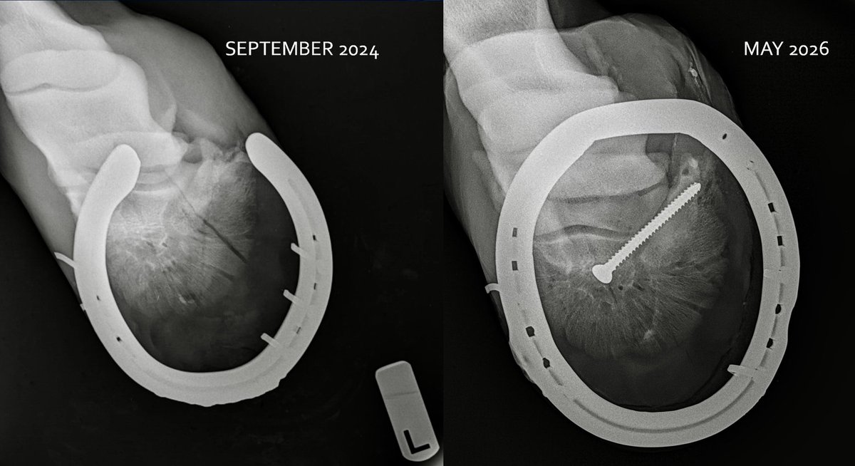 HoganEquine's tweet photo. BONE is an incredibly dynamic tissue and if you can get 2 fracture ends lined up reasonably well, you can basically create a nearly bionic structure! 🤪We repaired a serious coffin bone fracture in this STB mare in 2024 and happened to see her back this week for an unrelated minor issue.  Well we took a peek - her previous fracture has healed beautifully and she is now 33 starts in, nearing $400k in earnings, and sporting a new lifetime mark of 1:51.1f - we are so impressed by her (and ...the awesomeness of bone healing! 💪💪💪)