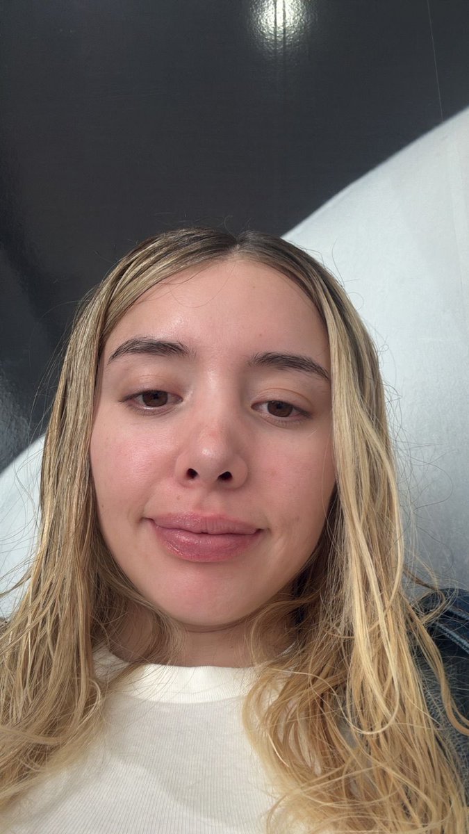 eslapbb's tweet photo. antes y después de un drenaje linfático facial alvqpdo la Hailey tenía razón loco https://t.co/N75ihu6Jwe