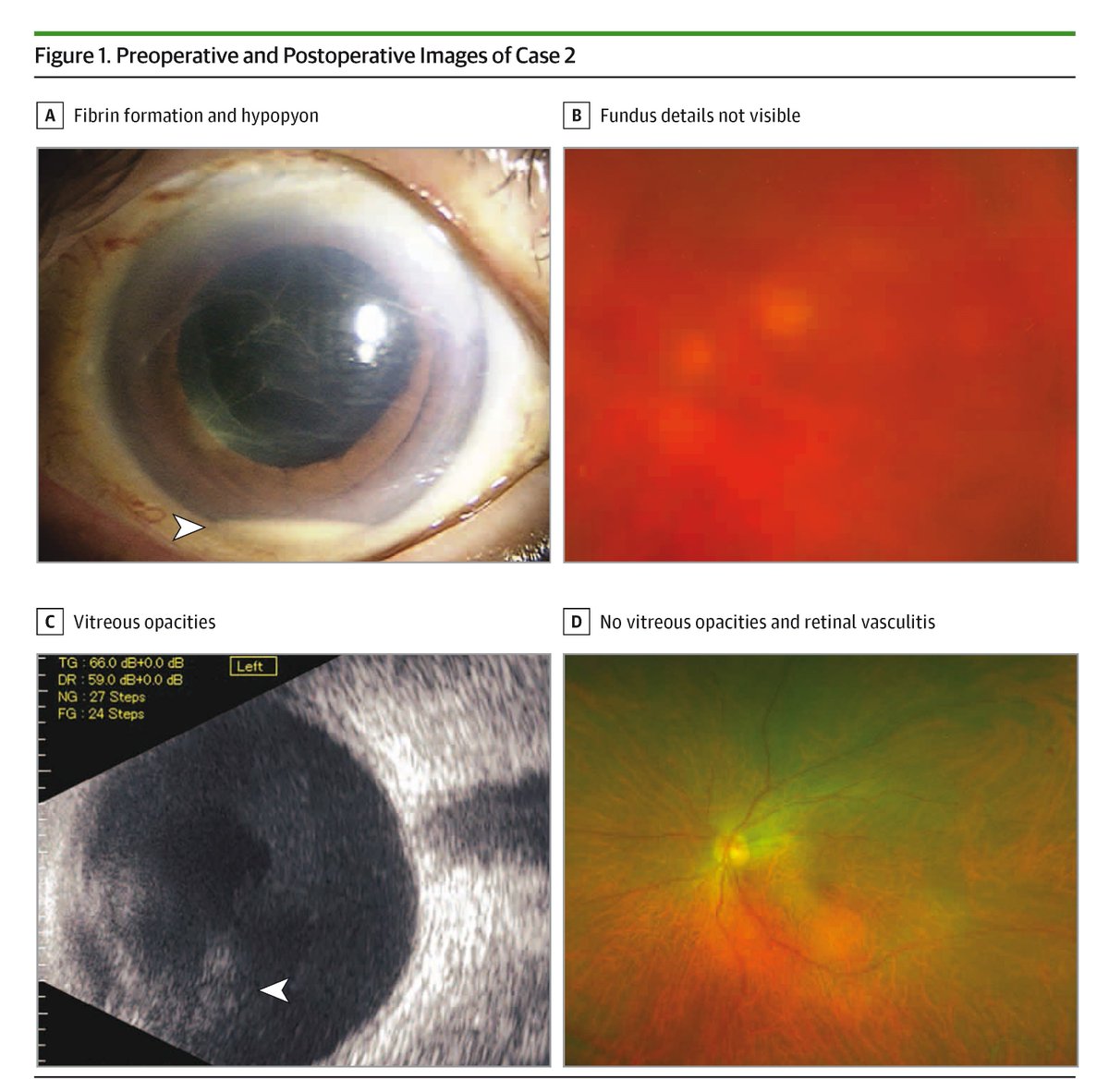JAMAOphth's tweet photo. Six cases of postoperative fungal #Endophthalmitis after #CataractSurgery were linked to Sarocladium kiliense contamination in off-label trypan blue solution, emphasizing the need for sterilization and infection control. https://t.co/CFNhGssb7L https://t.co/q10uK0mlhy