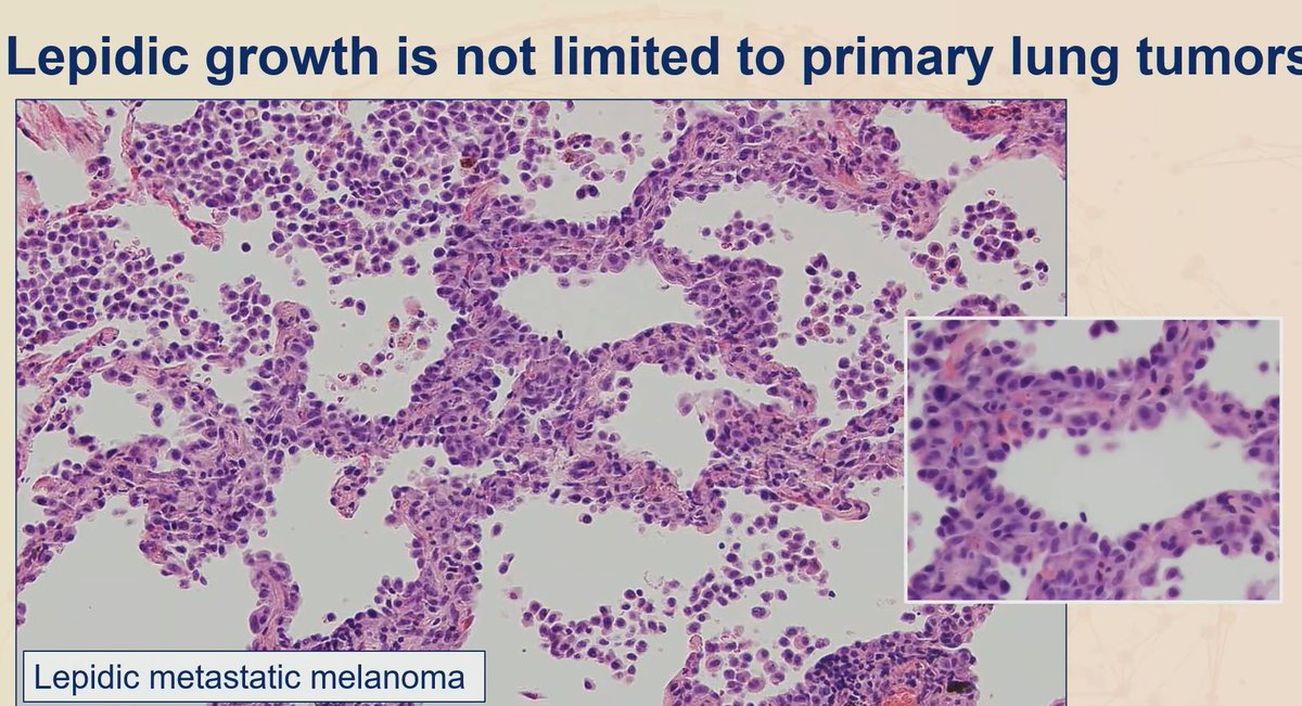 Janiranavarro's tweet photo. ***Lepidic pattern is not limited to primary lung tumors***

- Female patient with history of breast cancer now with lung lesion (pic 1 and 2): Mesothelioma, epithelioid type
- Melanoma (pic 3)
- Cholangiocarcinoma (pic 3)

Practical lession: Lung tumors that looks like carcinoma but negative for TTF-1 and p40, add Claudin 4 and WT-1 to exclude the possibility of mesothelioma

Dr. Sauter   #USCAP2026 #pathology #PathX #PathTwitter