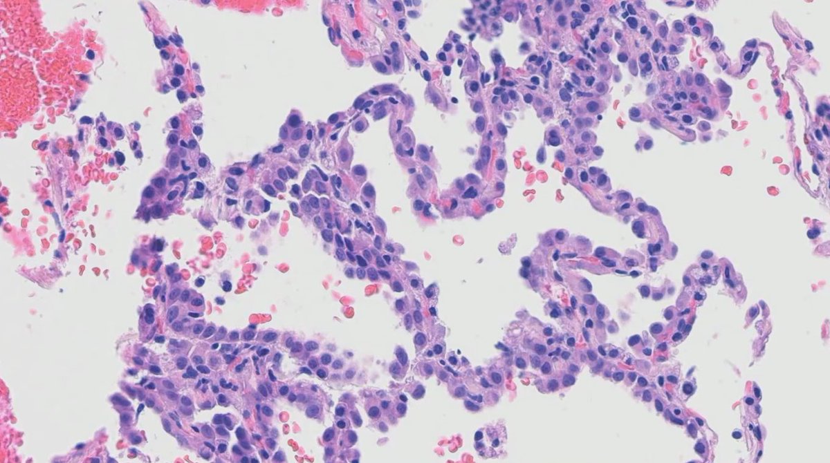 Janiranavarro's tweet photo. ***Lepidic pattern is not limited to primary lung tumors***

- Female patient with history of breast cancer now with lung lesion (pic 1 and 2): Mesothelioma, epithelioid type
- Melanoma (pic 3)
- Cholangiocarcinoma (pic 3)

Practical lession: Lung tumors that looks like carcinoma but negative for TTF-1 and p40, add Claudin 4 and WT-1 to exclude the possibility of mesothelioma

Dr. Sauter   #USCAP2026 #pathology #PathX #PathTwitter