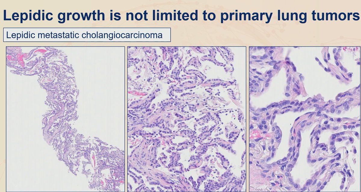 Janiranavarro's tweet photo. ***Lepidic pattern is not limited to primary lung tumors***

- Female patient with history of breast cancer now with lung lesion (pic 1 and 2): Mesothelioma, epithelioid type
- Melanoma (pic 3)
- Cholangiocarcinoma (pic 3)

Practical lession: Lung tumors that looks like carcinoma but negative for TTF-1 and p40, add Claudin 4 and WT-1 to exclude the possibility of mesothelioma

Dr. Sauter   #USCAP2026 #pathology #PathX #PathTwitter