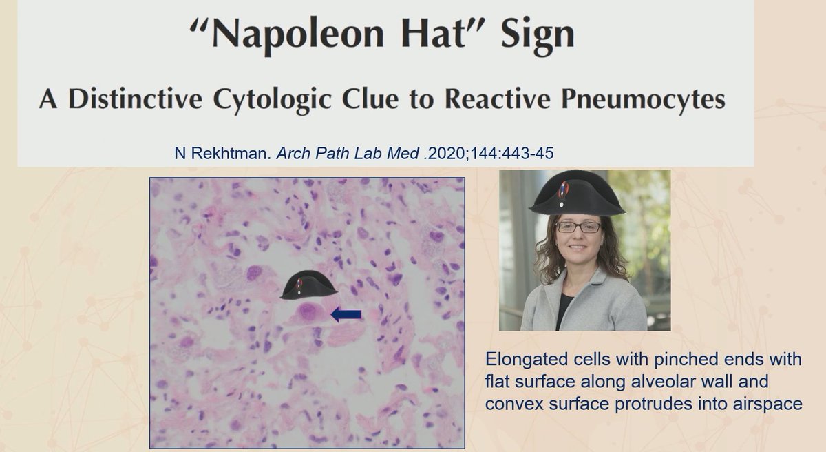 Janiranavarro's tweet photo. Lung
**Reactive pneumocytes vs malignant cells**

Reactive
- Spectrum of atypia
- Cytoplasmic vacuolization
- Maintained N/C ratios
- Cytology: Napoleon hat sign

Dr. Sauter #USCAP2026 #pathology #PathX #PathTwitter https://t.co/zUhcdc3s33