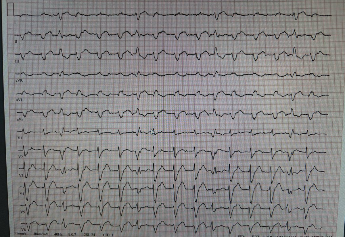 ecgchallenge's tweet photo. A patient with NICMP. Taking amiodarone due to a history of VT. What do you think the rhythm is? https://t.co/G5KbENH9RY