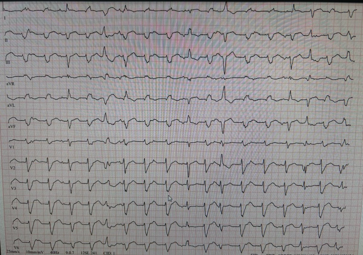 ecgchallenge's tweet photo. A patient with NICMP. Taking amiodarone due to a history of VT. What do you think the rhythm is? https://t.co/G5KbENH9RY