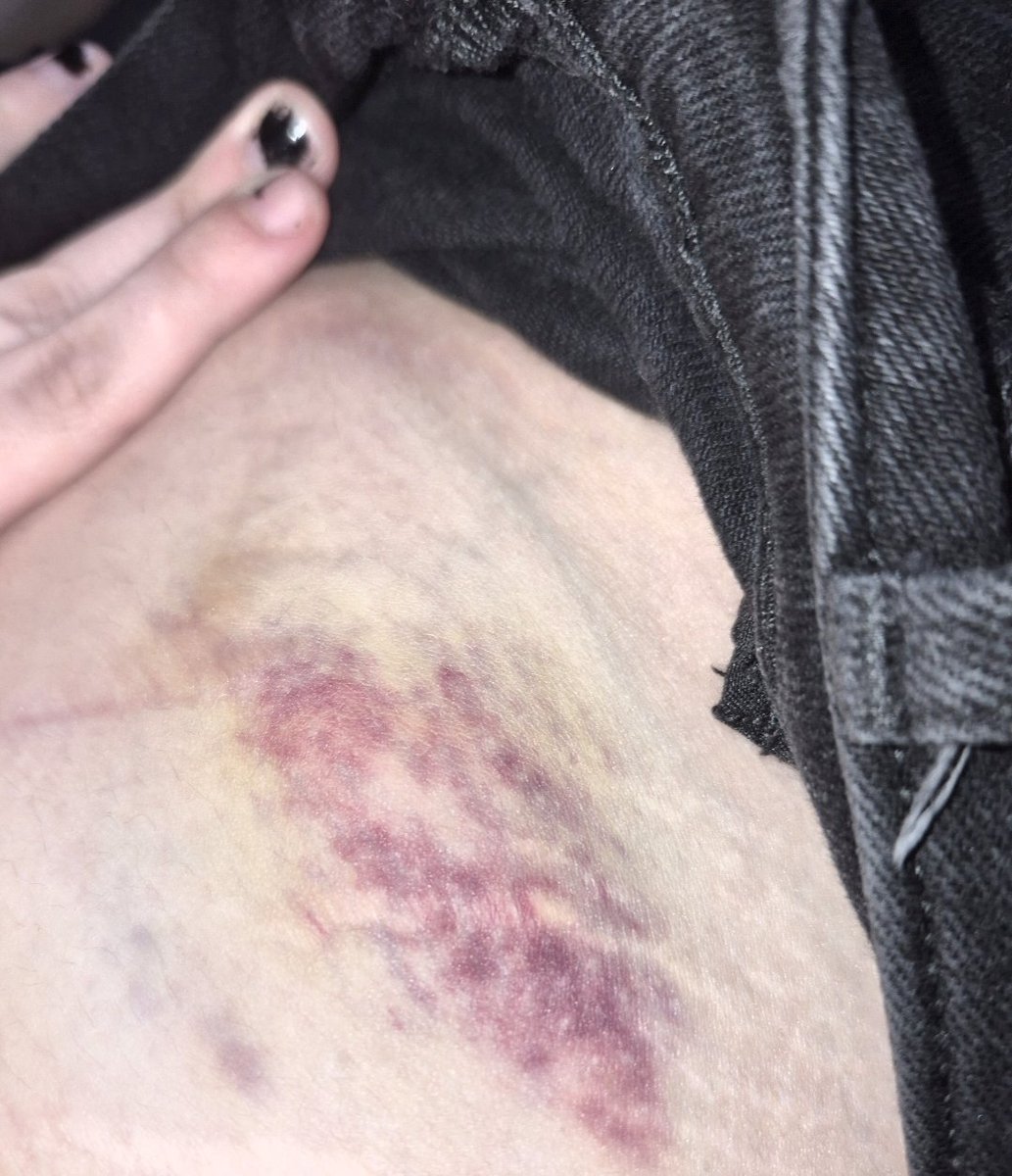 Incelpuppyboy's tweet photo. [• #nsfwtwt • #sadomaso • #freak •]

Really thinking about that bruise from early May cause I was a brat to my boyf....... #BringThatBack https://t.co/KGM8tjcWCf