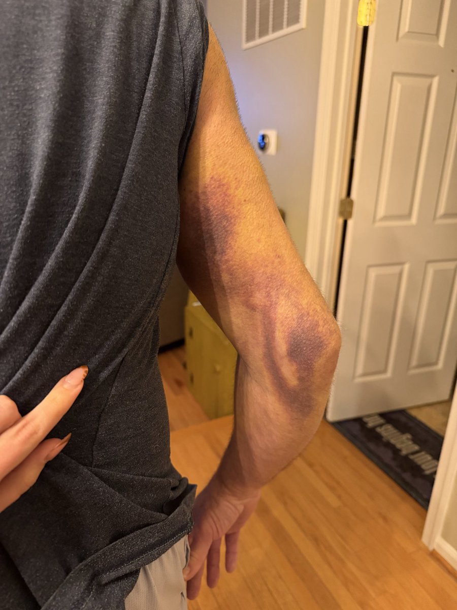 fergdaddy16's tweet photo. @Incrediwear I wanted to express my gratitude for your support during my (Service Connected) shoulder revision surgery  I purchased a "recovery sleeve" due to swelling and bruising, the product wouldn't fit. I am thankful that you send me an additional one. https://t.co/2cWhvSm96L