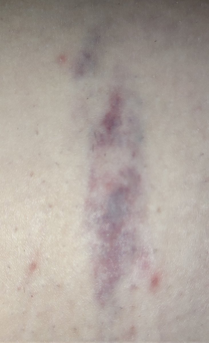 MPilardance's tweet photo. Yo soy la novia y esto es lo que me quedado de la estampida de hoy menudo golpe me ha dado un chico por ir huyendo de la policía https://t.co/aFPo9h310K
