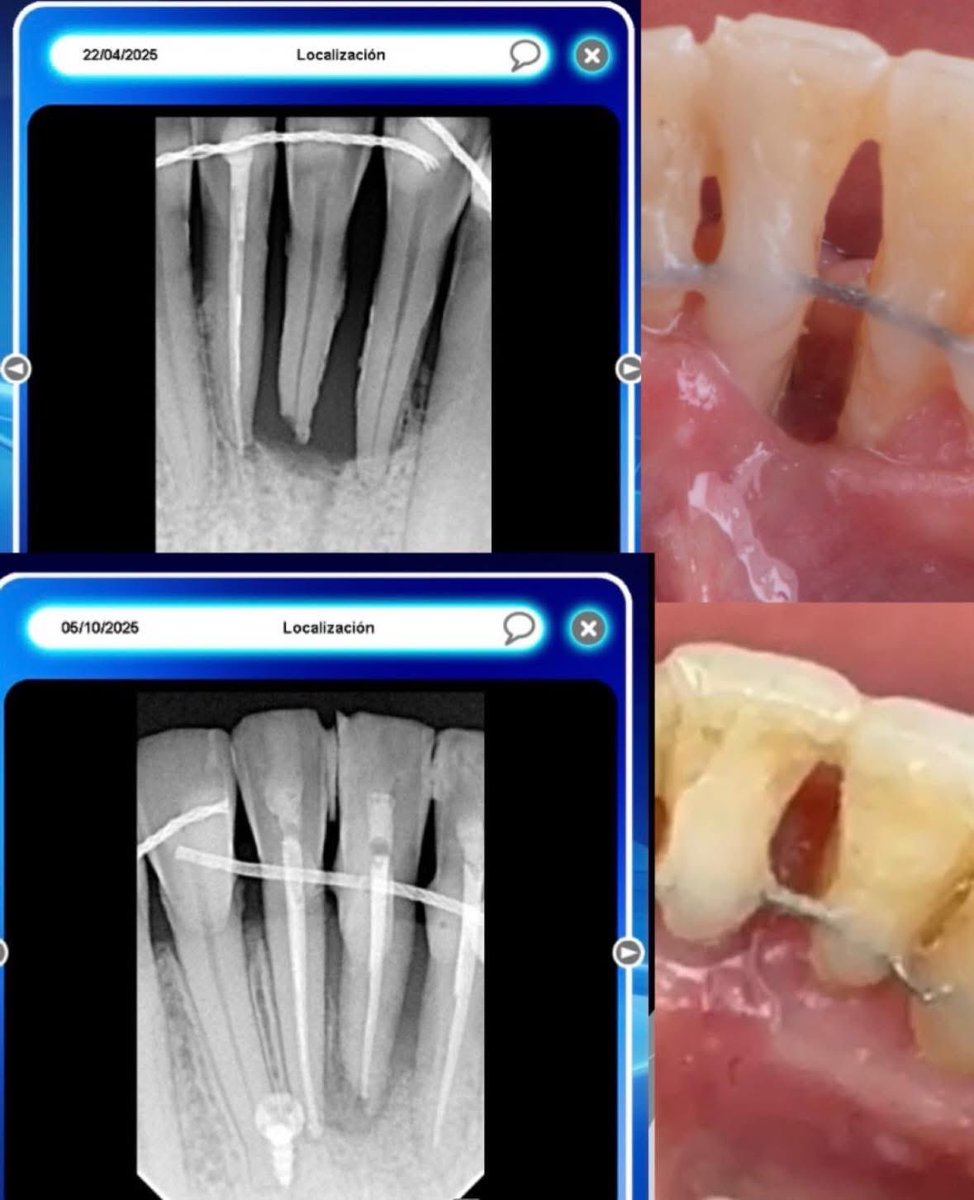 OviDentalGo's tweet photo. 👉 About when to save or when to extract. Clinical case By Dr. Jerian González Febles https://t.co/43YjzjA19T https://t.co/NsMTvQjsWx