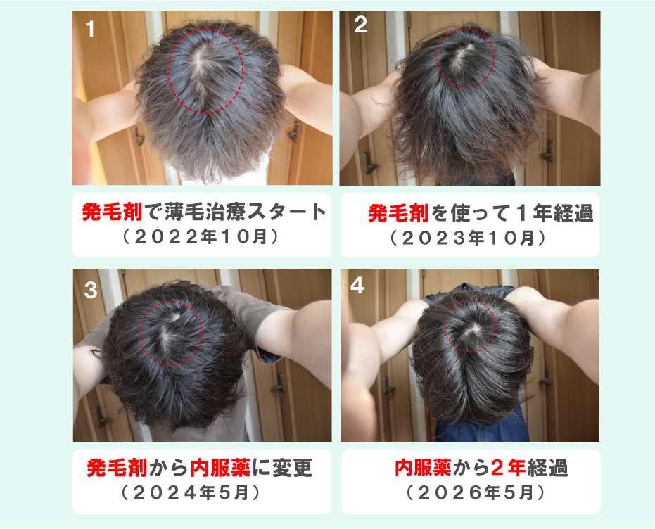 イクタ(39歳) | 元つむじハゲ・現在もM字ハゲ対策中 tweet media