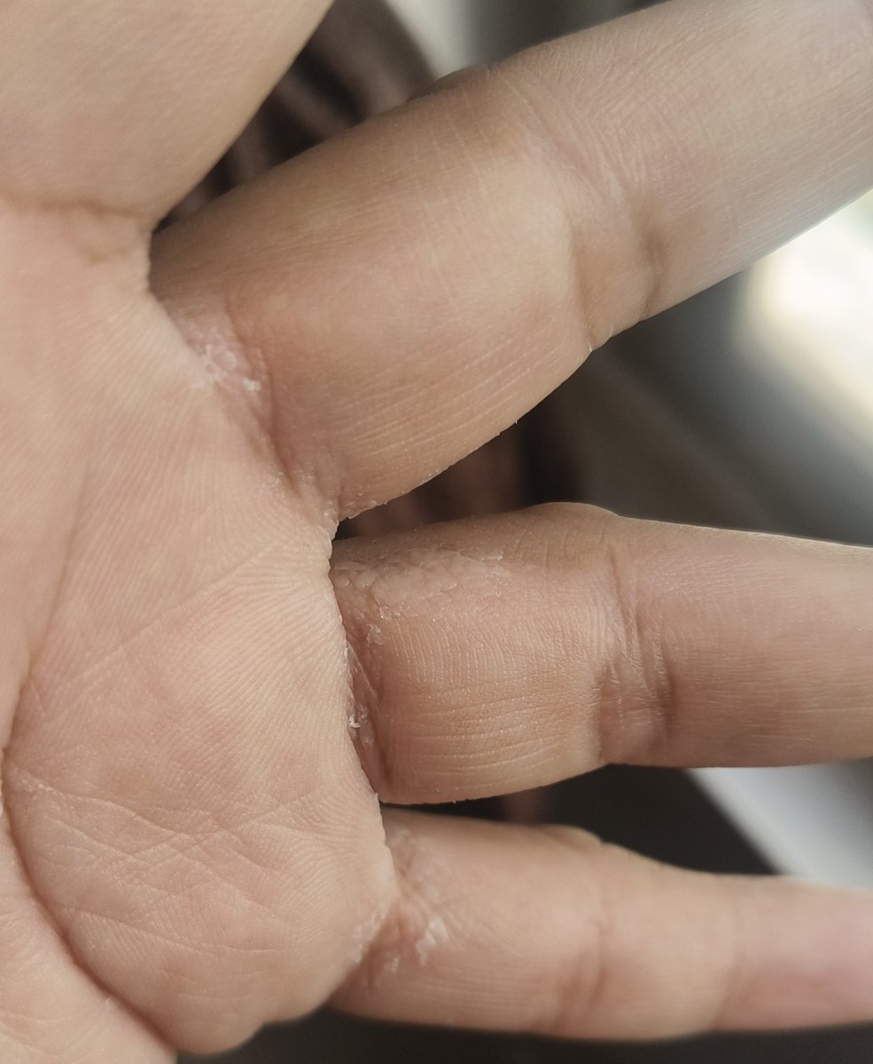 RohitKaNation's tweet photo. Hey @grok, tell me what kind of infection is this between the fingers and how can it be cured 🤔 https://t.co/kVVOZ4Sl9M