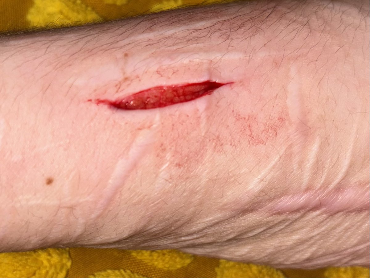 slitzblades's tweet photo. found a dull blade and i did ts sigh it's so small but it bled sm a pain in the ass tbh https://t.co/tqXbMVrpJN