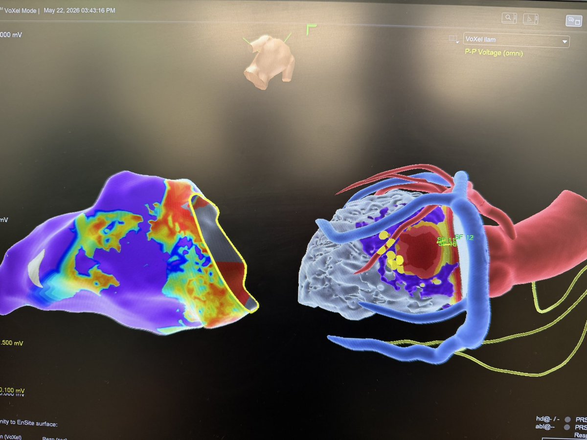 sumitvermaep's tweet photo. 90 year old male with ICM and refractory VT. CS paced ILAM decel zone correlated well with site of concealed entrainment and termination. #abbottcardio #OTNF #ablateVT @slate11p https://t.co/D2NhPebLTb