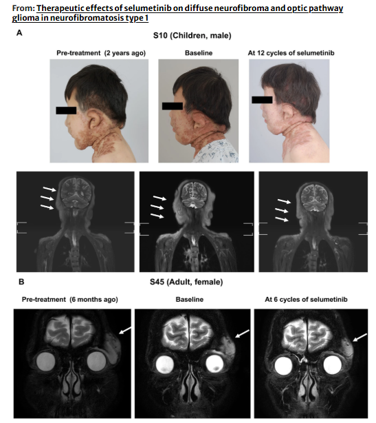 jasonpsheehan's tweet photo. A new study published in the Journal of Neuro-Oncology on the effects of selumetinib for NF1 patients https://t.co/qhMHGlSbX6