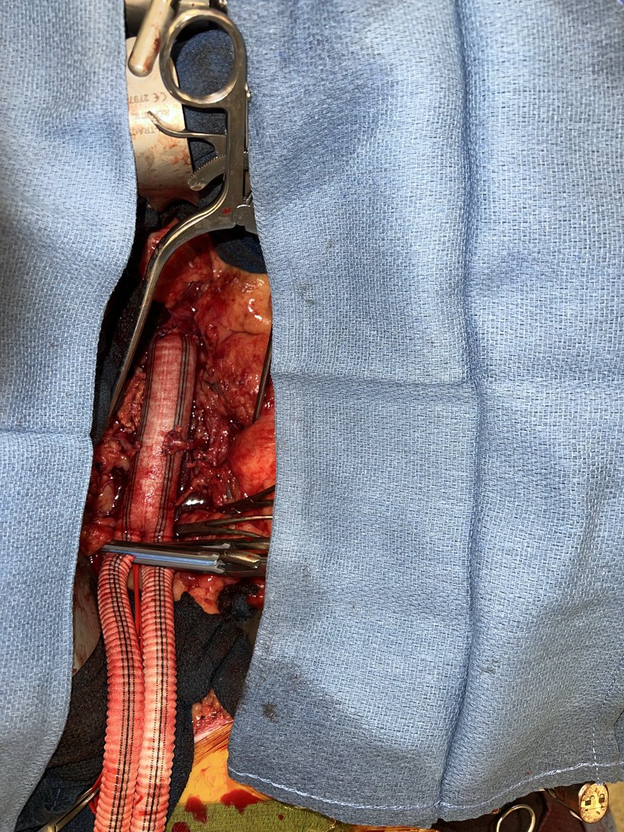 RafaMalgor's tweet photo. @thesurgerylife Nice, @thesurgerylife! Looks great, Eli, classic…tube graft. Reimplanting renal arteries is a must especially when there’s a pelvic kidney (left here) and a large accessory (right). A set of skills we try to teach and to pass along to our residents and fellows whenever possible. https://t.co/4oBMDh6r7d