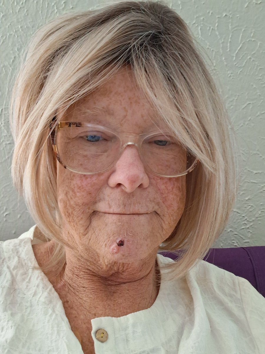 vbatcher50's tweet photo. Sporting 2 new do's. Thank you for the support during my #chemotherapy effects https://t.co/spsZkwN2ev