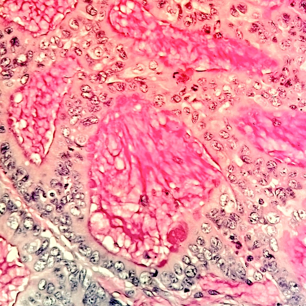 seoparjoo_'s tweet photo. Mucin stains. 40x magnification. Mucin producing adenocarcinoma of the colon. ~ Kanser usus besar.  #GIpath #pathology #patologi #cancer #kanser https://t.co/zHASVVHTta
