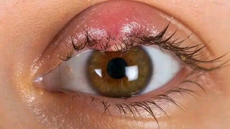 Avyansx's tweet photo. Hey @grok my friend's eyes are looking like this, what could be the reason?😔 https://t.co/loKDqUq6aG