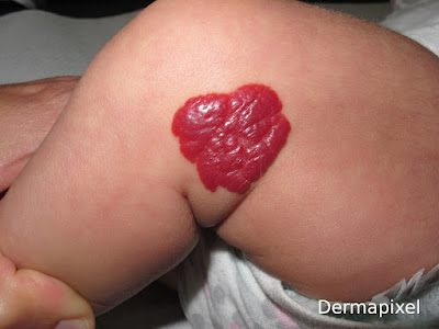 SCPed's tweet photo. 🔎"Un bebé con una mancha roja"
🧐Cas de dermatologia perdiàtrica del blog #Dermapixel de @rosataberner 
➡️https://t.co/1lk4hjhRZF https://t.co/7rkkvcZwDS