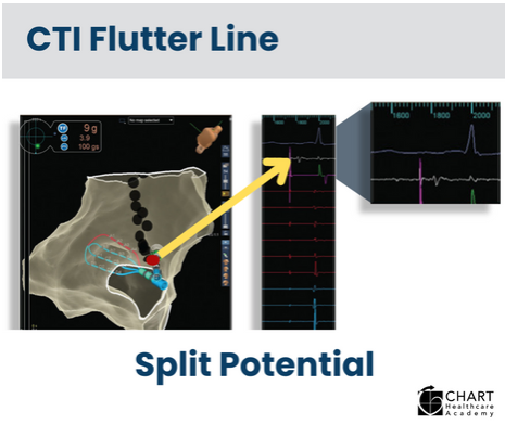 ChartAcademy's tweet photo. 🏖️ Spend you summer getting ready for the HOT SEAT in the EP Lab! Learn about the physiologic mechanisms that set tachycardias into motion. 🫀❤️‍🔥💥

Link in bio.
https://t.co/fsglQtN0YL

#EPeeps #VivaEP #CHARTCoach #CultureOfLearning #MedTechEd #WorkforceDevelopment https://t.co/xRJaHHbyjn
